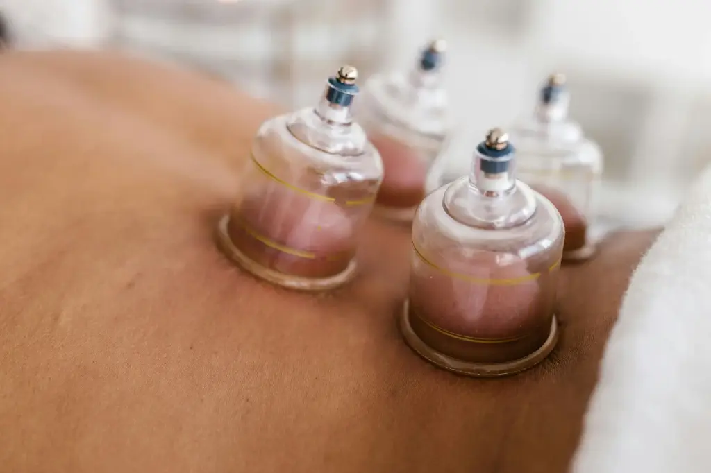 Cupping en Guasha