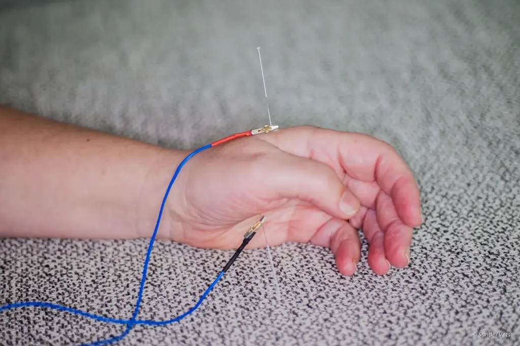 Electro Acupunctuur (okt '26)