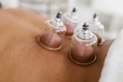 Cupping en Guasha (mrt '27)